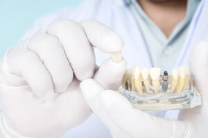 Dental Implants